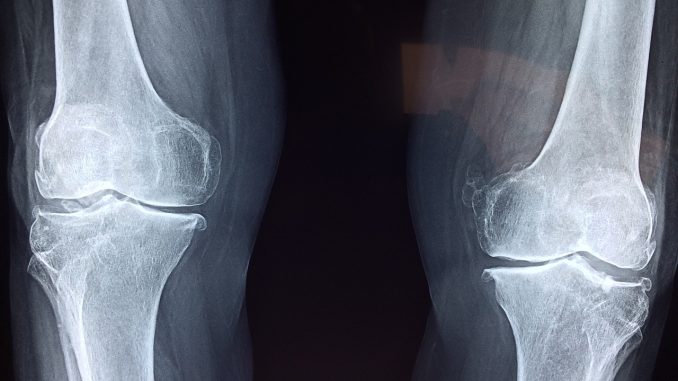 Collagen for joints (especially for injuries and older athletes)